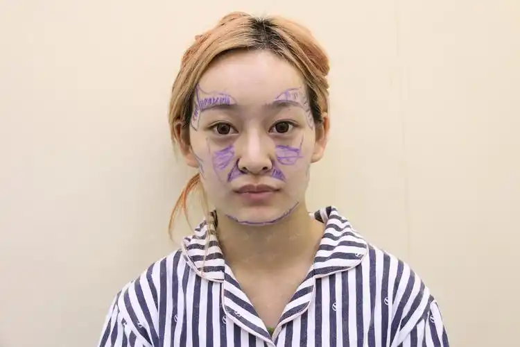 自体脂肪填充面部后,如何进行消肿护理?