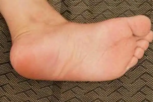 女人要看脚就知道命运,女人脚上有拇外翻就是劳累的命吗