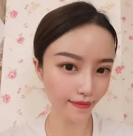 谁有全脸自体脂肪填充5到10天照片呢