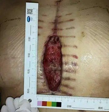 "心脏大血管手术术后胸骨正中切口愈合不良伴感染是术后严重的并发症