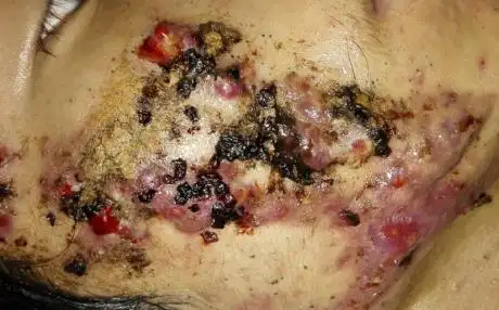 痘痘(痤疮)能挤吗?