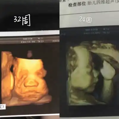 大家好,帮忙看看宝宝的两次四维照,鼻子是不是好大好塌好短啊,生出来