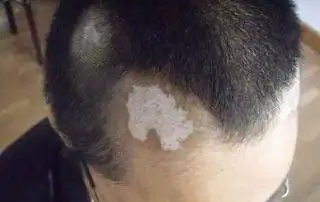 发迹间出现白斑是头部白斑病吗