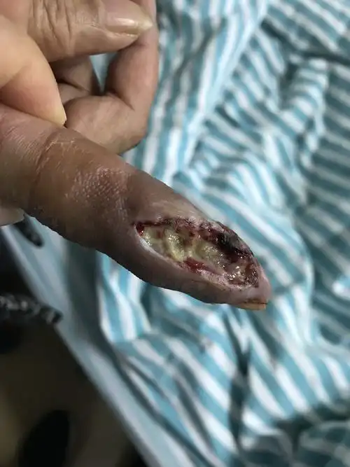 开始溃烂鱼刺伤,手指烂