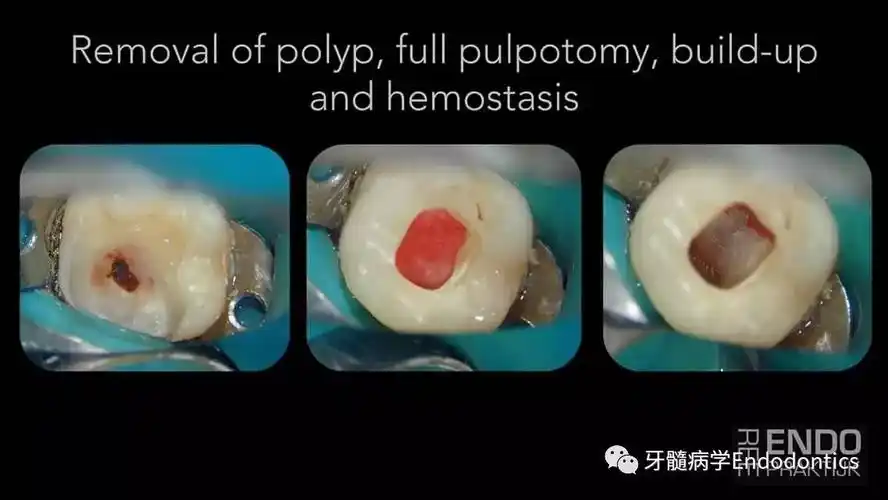 下颌第一磨牙活髓切断一例