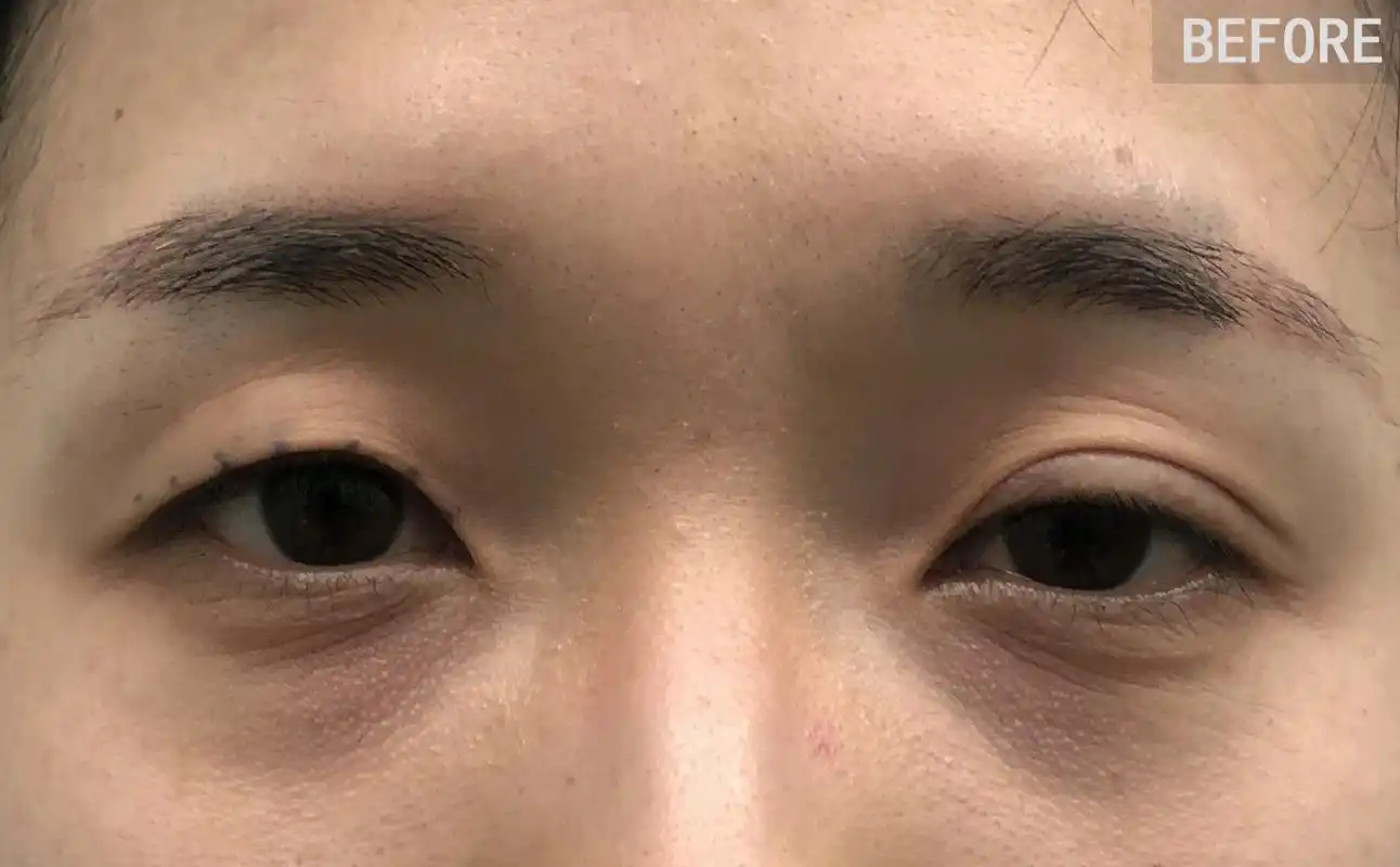 双眼皮一单一双,皮肤松弛上睑肌无力,太复杂了怎么改善?