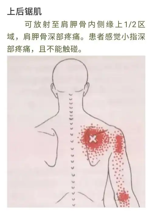 肩胛骨内侧缘疼痛,可能是这十块肌肉劳损了!