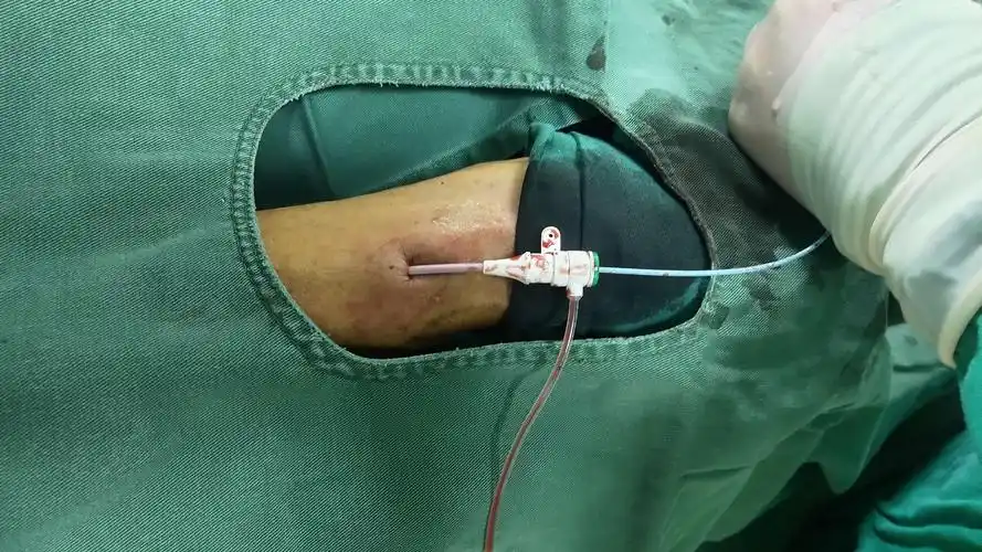 外周介入手术更加舒适--驻马店市中医院介入科开展第一台经桡动脉穿刺