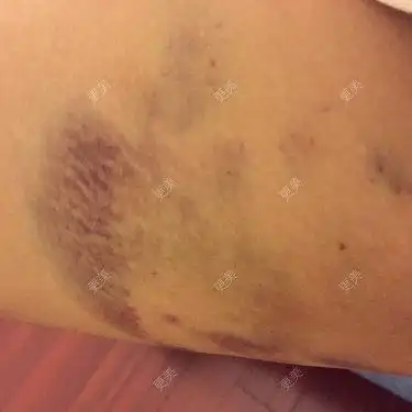 第一次打完溶脂针第二天大腿内侧的淤青越来越严重了是不是有什么问题