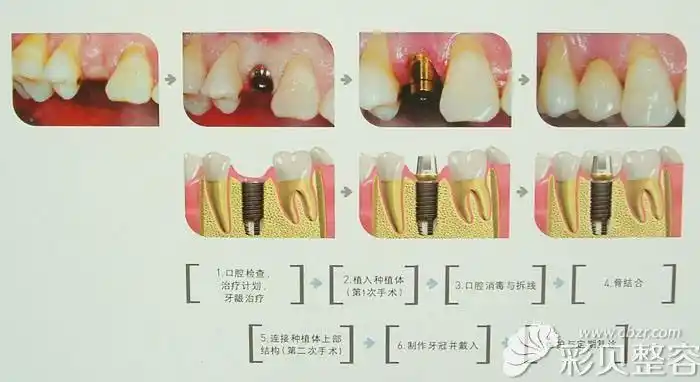 什么是种植牙?北京煤炭总医院口腔科杨传才视频在线讲解 - 整容视频 -
