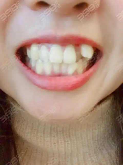 上海正畸虎牙的牙科有推荐吗?