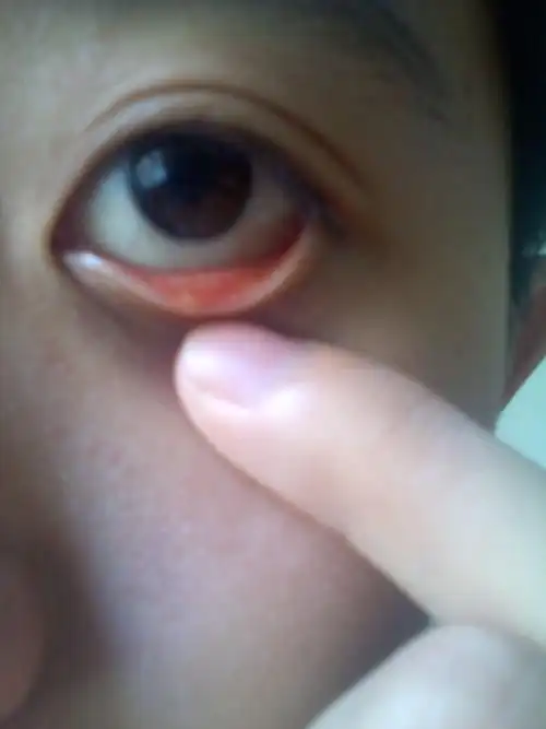 下眼皮内长这个是什么?