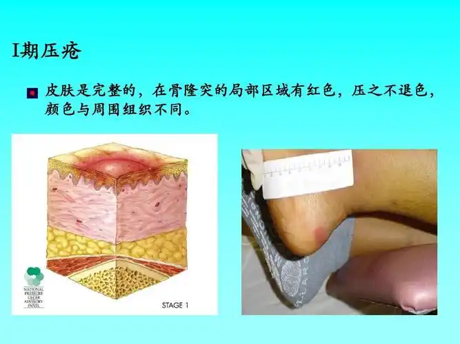 i期压疮 皮肤是完整的,在骨隆突的局部区域有红色,压之不退色, 颜色与