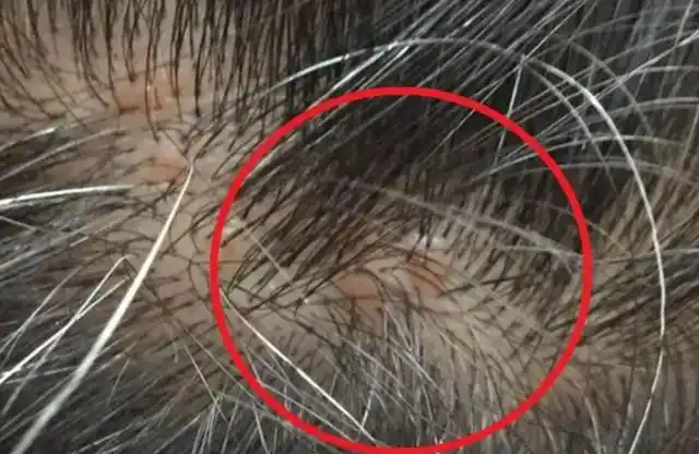 头皮上总"长痘痘",抠破还疼?或许是2点在作怪,还真不能小瞧