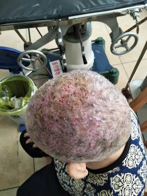 头皮多发性化脓性毛囊炎病例一例