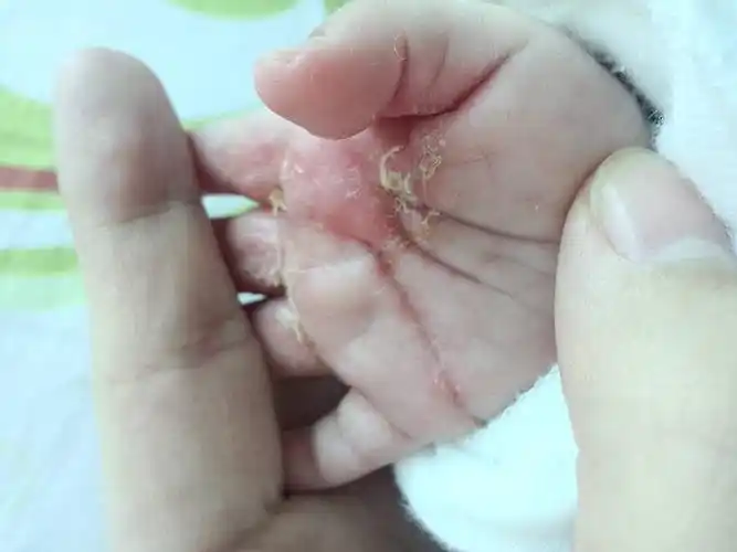 11:22     为您推荐: 其他回答 从照片上看,宝宝手掌局部皮肤蜕皮明显