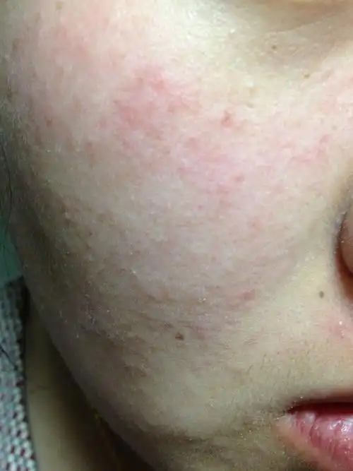 很多人在情绪激动或者压力大的时候会出现皮肤过敏的症状,这给人们的