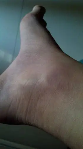 脚崴半年了,脚踝骨下面的小骨凸出来了,是骨头错位吗,走路不影响.