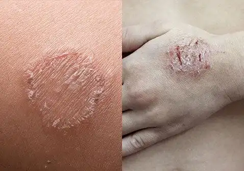 湿疹和癣的区别对比图片