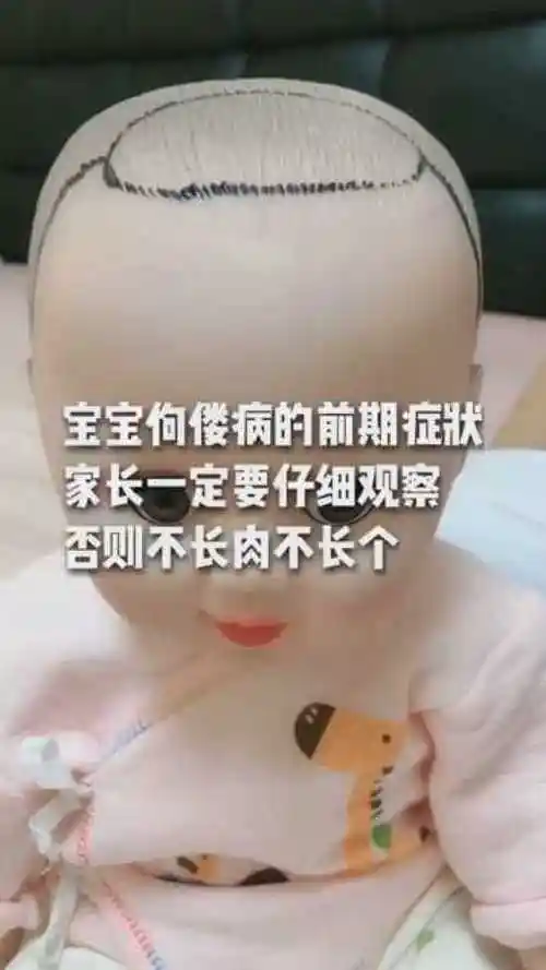 宝宝佝偻病的前期症状家长们一定要仔细观察