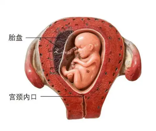 【妇产科普】不老实的胎盘,竟成孕妇"生死劫"!_前置_宫颈_位置