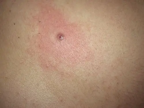 痘痘总扣,结痂后又不小心弄掉了,现在是褐黑色,怎