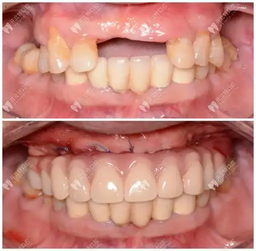 allon4上半口种植牙前后效果对比图