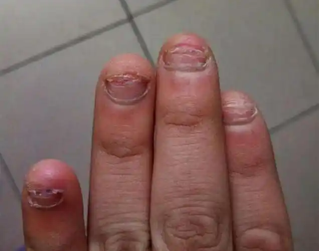 小孩经常啃指甲缺什么(孩子爱啃指甲不是缺维生素)(4)