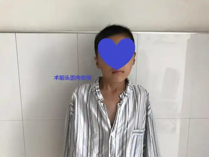 安徽歪脖子斜颈患者在徐州二院骨科找高绪仁关节镜微创手术的经验分享