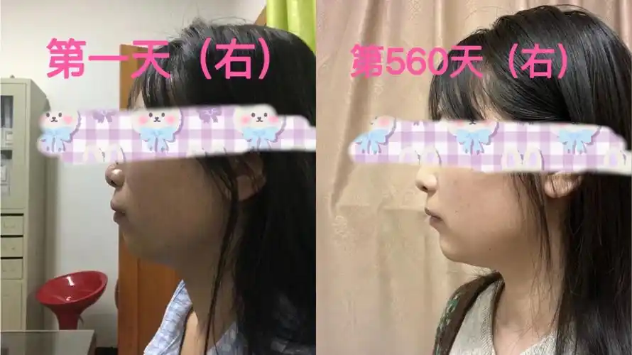 昆明正畸成人牙齿矫正骨性拔牙