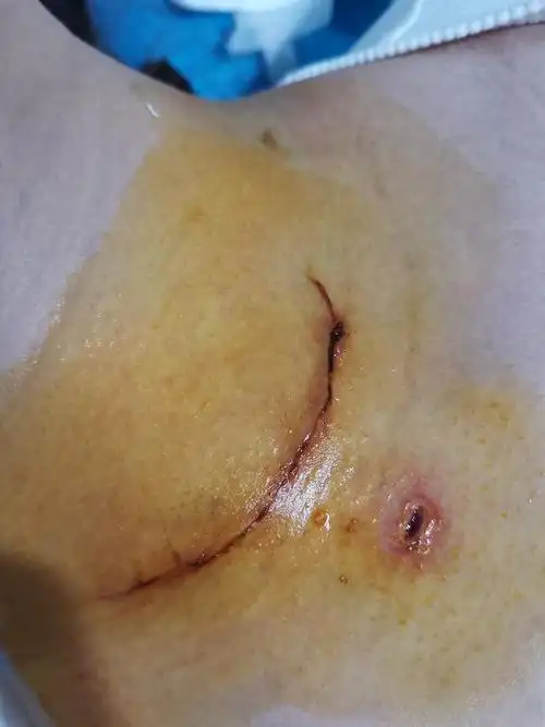 伤口还是有点吓人哈,下面的小洞是手术插的引流管.
