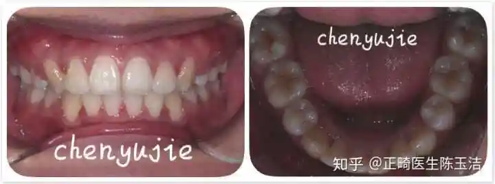 疲劳,对他来说,做正畸美观是次要的,主要是为了自己的牙齿能恢复正常