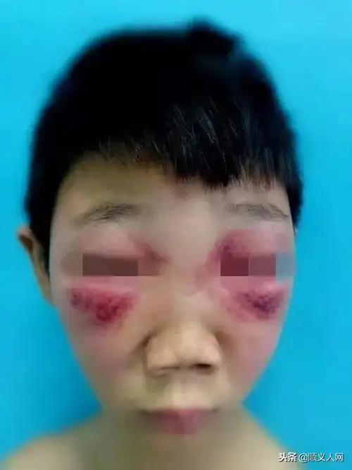 虚弱的小陶额头贴着退热贴,眼睛红肿得像水泡金鱼,只剩下了一条细缝