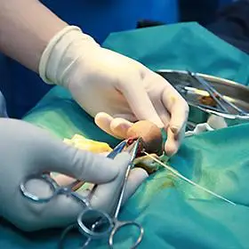 韩式微创包皮整形术