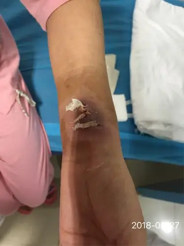 留置针针眼感染