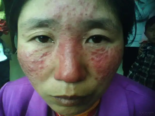 治疗前后的颜面部皮肤病(附图)