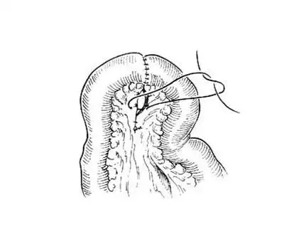 小肠端端吻合术过程图手术图解