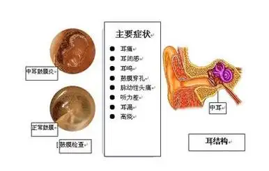 外耳道炎症状1,外耳道炎时耳痛剧烈,张口咀嚼时加重,并可放射击至同侧