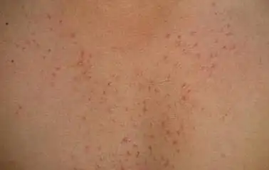 张某,男,前胸大面积毛囊炎