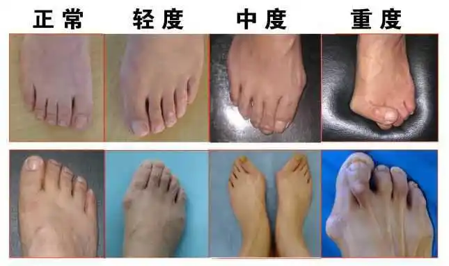 骨科科普 | 成人脚码还能变大吗?当心是拇外翻