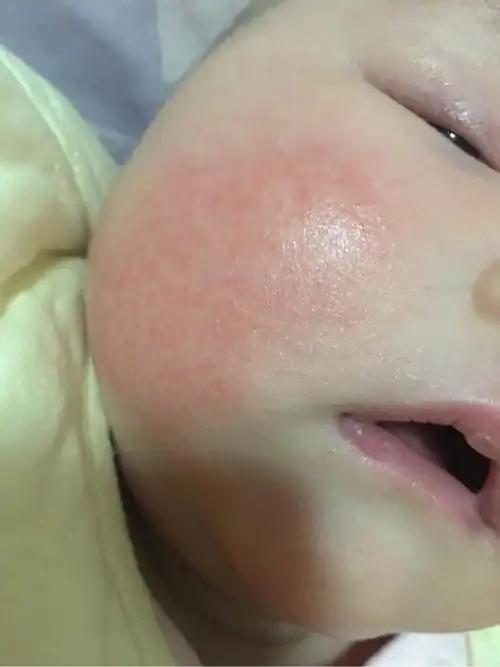 宝宝脸上突然有红血丝