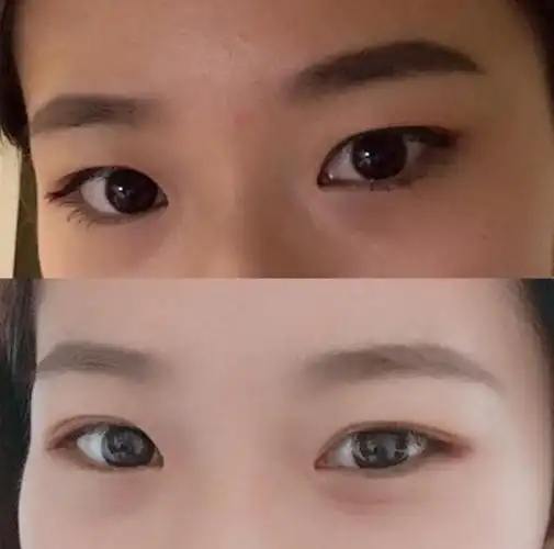 南华博士:内双割双眼皮好吗?需要注意什么?