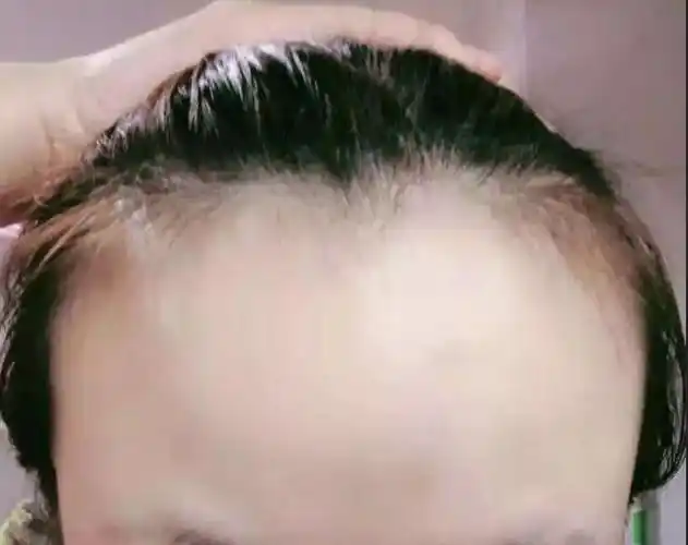 而日常生活中也有不少人的发际线都偏高