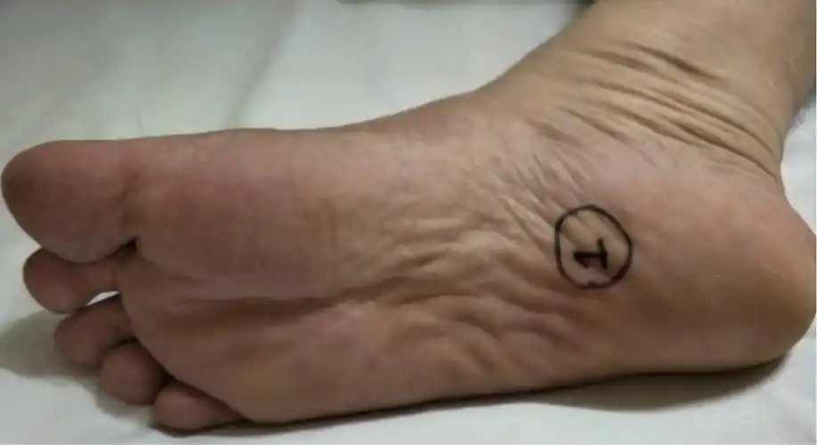 足底筋膜炎的诊断和治疗要点.