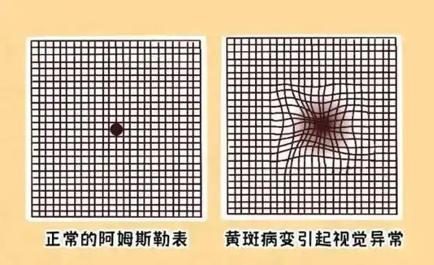 看东西模糊,变形?可能不是"老花眼"哦