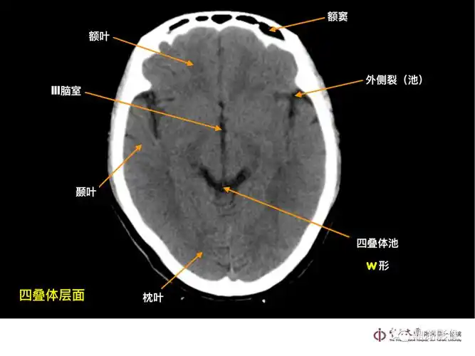 超实用急诊头颅ct3b阅片法