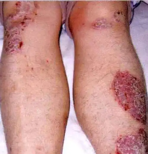 村医学习最全常见皮肤病图谱附口服外用联用药