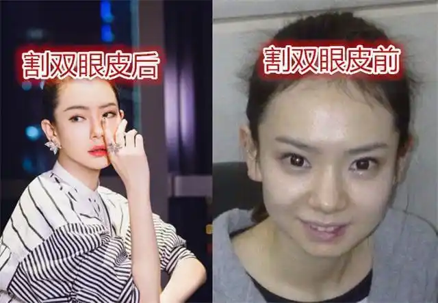 戚薇自曝割双眼皮,前后颜值差别太大,网友:根本不是一个档次
