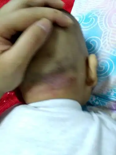 宝宝后脑勺长的什么东西?要怎么处理?急急急.