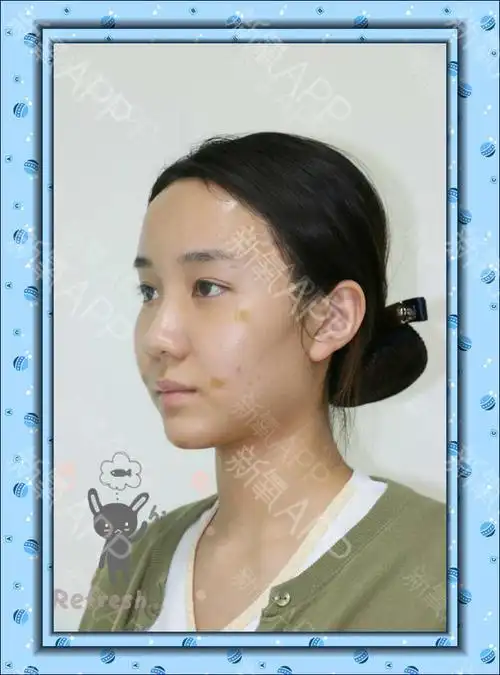 氧气zyr62自体脂肪全脸填充第15天美丽日记